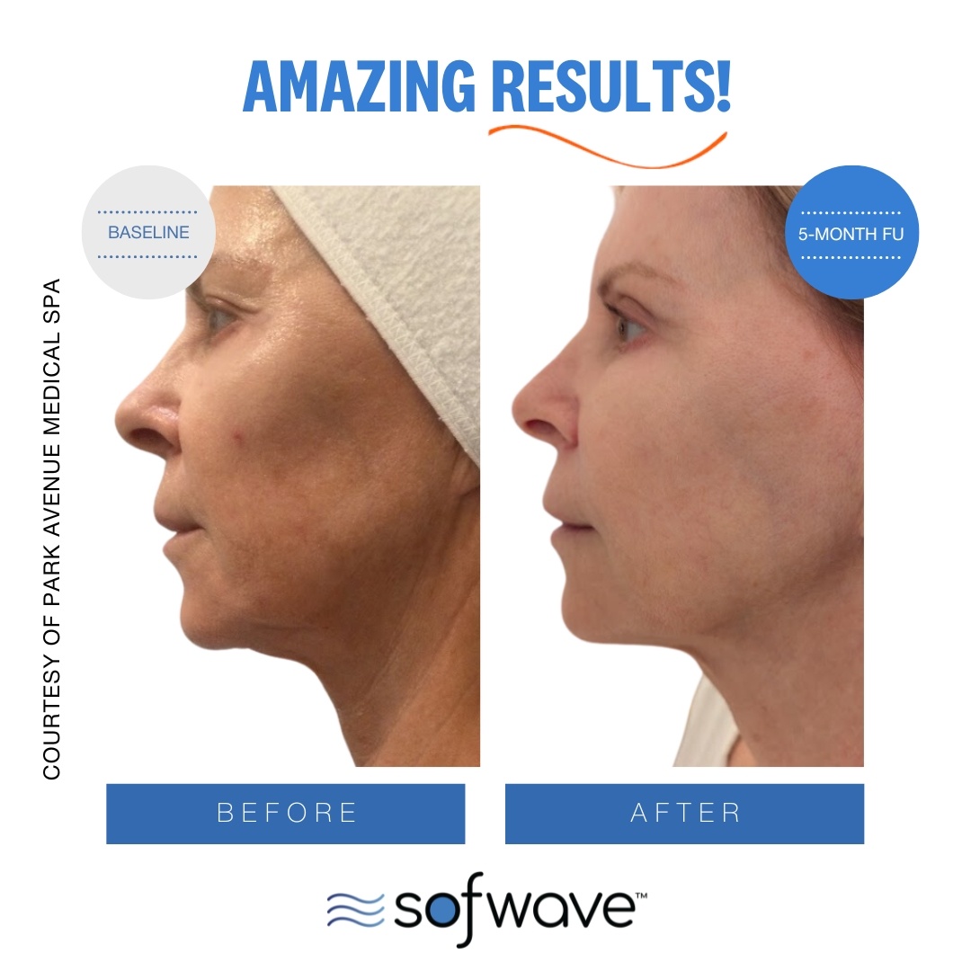 Orlando Skin Tightening Sofwave