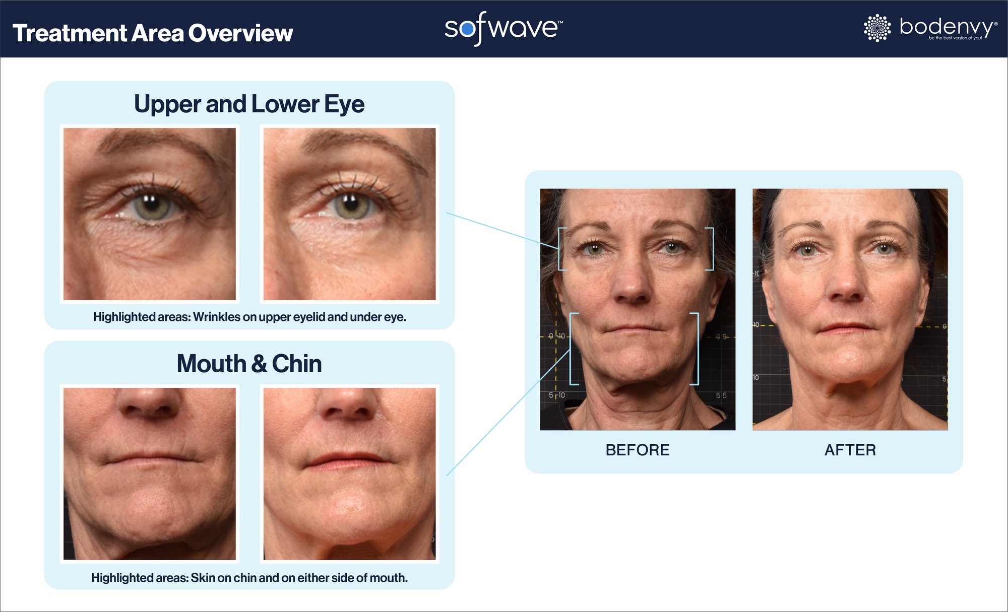 Sofwave Before and After 1A 1B_1A