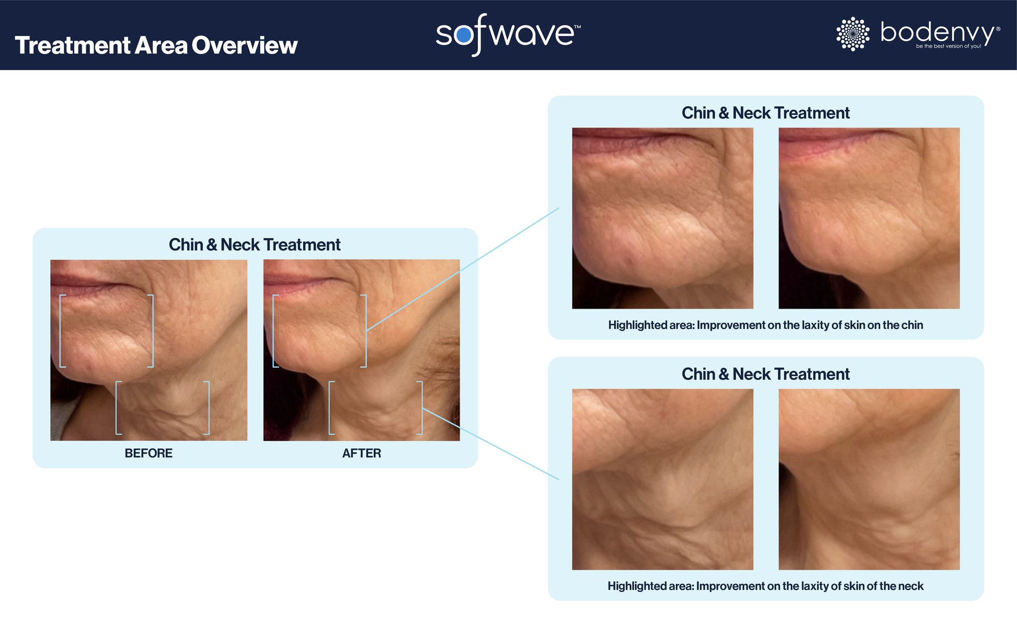 Sofwave Before and After 3-1