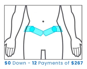 coolsculpting love handles