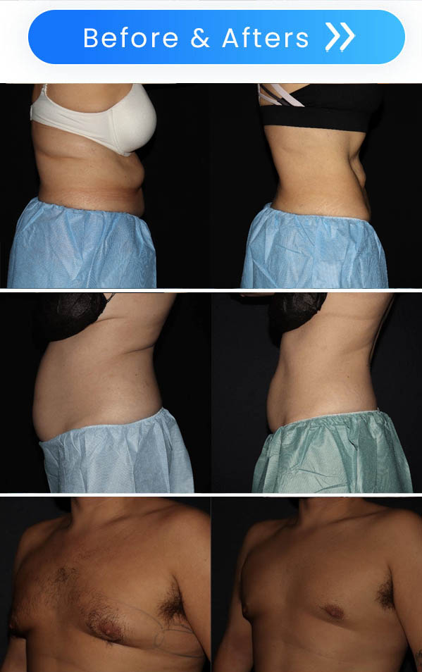 Bodenvy-Before-and-After-CoolSculpting-Orlando