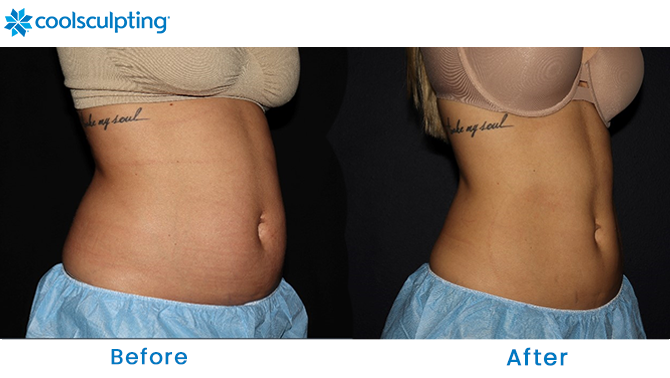 Before & After Gallery, Body Sculpting